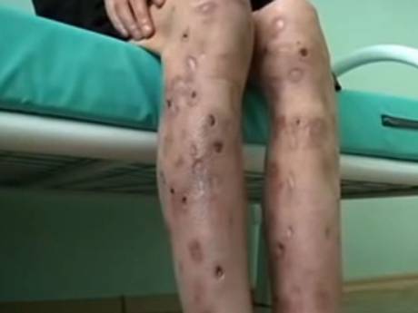 This is an image of a Krokodil user's legs in the early stages of taking the drug. Any images of the more advanced stages of usage are way too graphic.